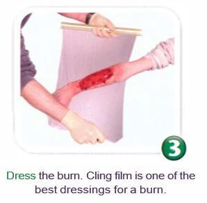 Dealing With Burns And Scalds | First Aid Training